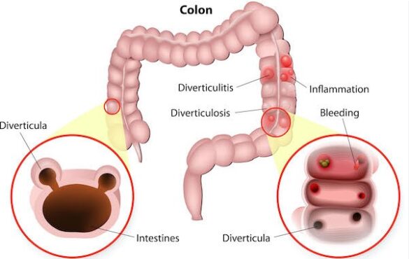 Diverticulitis